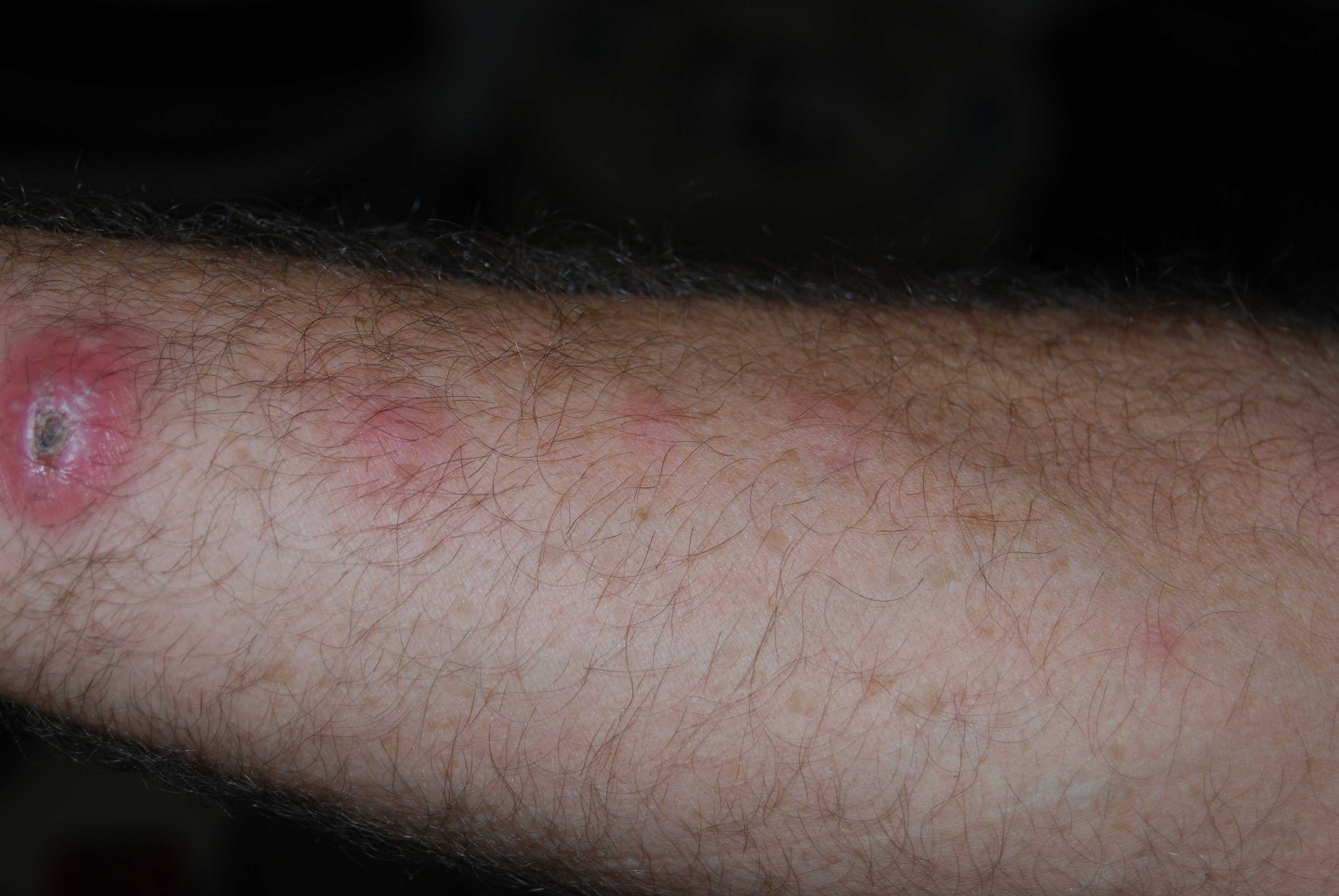 Gardening Splinter Risk