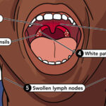 Child experiencing strep throat symptoms