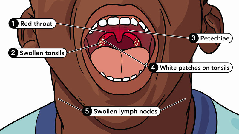 Child experiencing strep throat symptoms